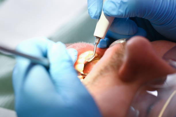 Best Emergency Root Canal Treatment in Robins Af, GA